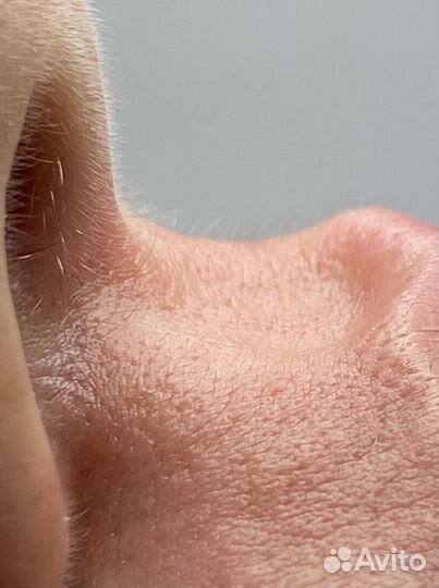 Электроэпиляция