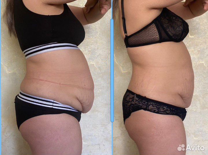 Антицеллюлитный массаж Аппаратный массаж