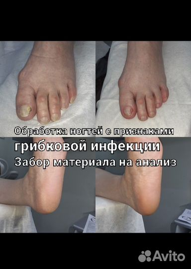 Подолог, аппаратный педикюр