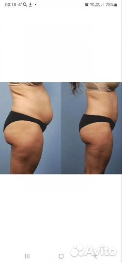 Аппаратные процедуры для лица и тела