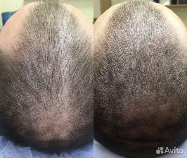 Трихопигментация