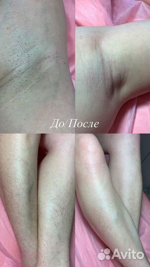 Шугаринг Витязево