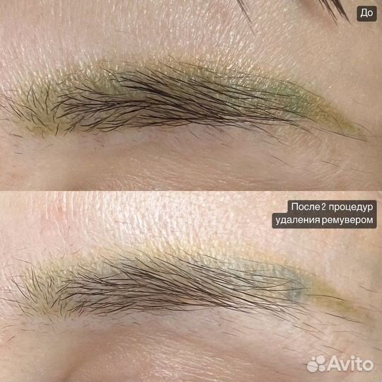 Удаление татуажа/тату ремувером/лазером, Перманент