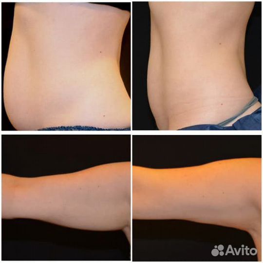 Жиросжигание Фито Гелем /Коррекция фигуры