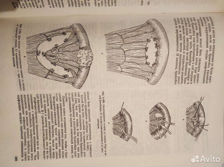 Хирургия Литтманна