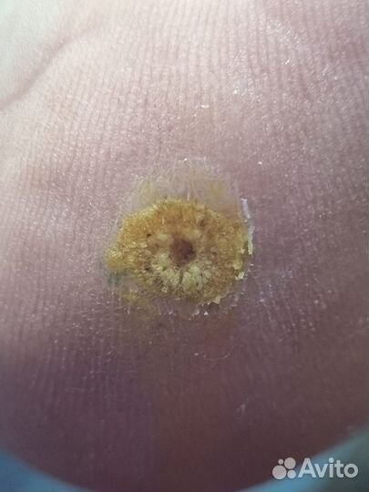 Стержневые мозоли, бородавки, Подолог Липецк