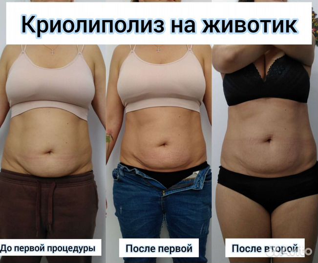 Криолиполиз Массаж Кавитация (коррекция фигуры)