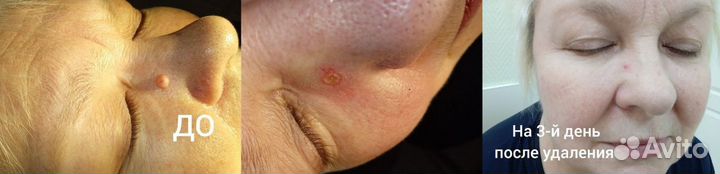 Лазерное удаление родинок, папиллом, бородавок