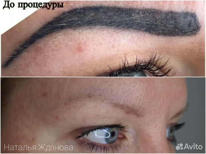 Удаление татуажа перманентного макияжа