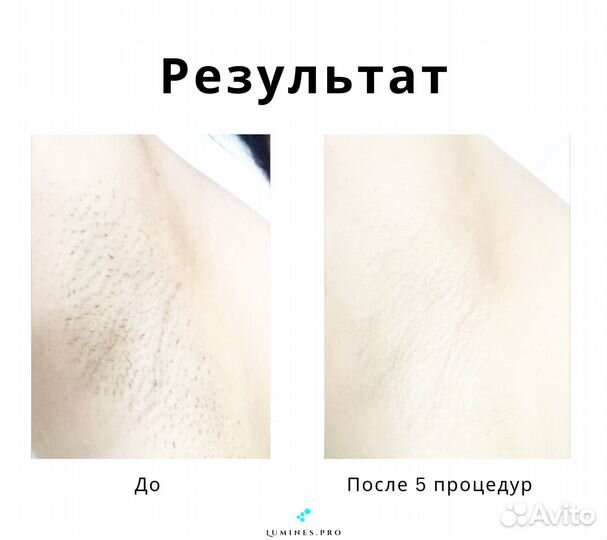 Аппарат для эпиляции «Lumines» Max One 1200