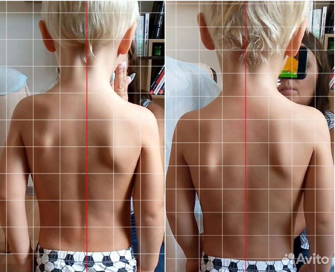 Массаж. Коррекция сколиотической осанки