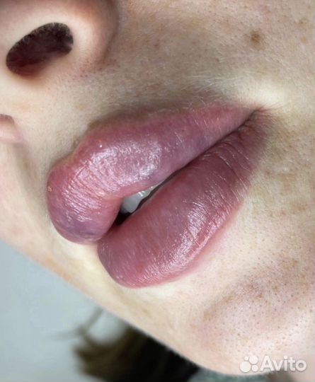 Увеличение губ