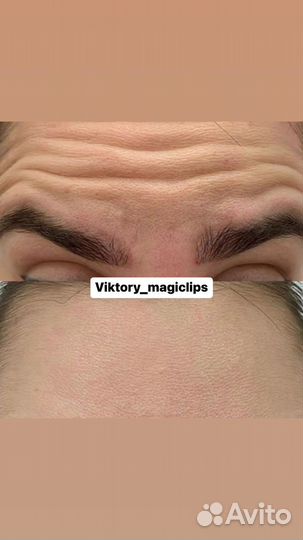 Ботокс для лица