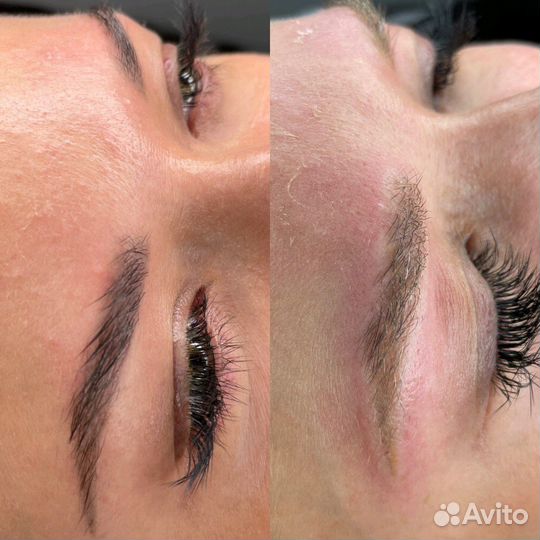 Удаление татуажа