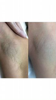 Лазерная эпиляция